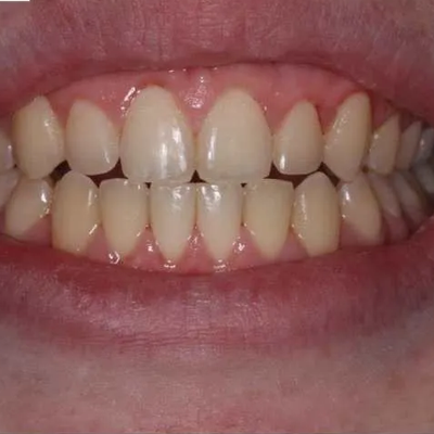 Before treatment