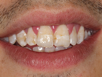 Before treatment