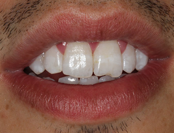 After treatment