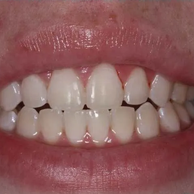 After treatment