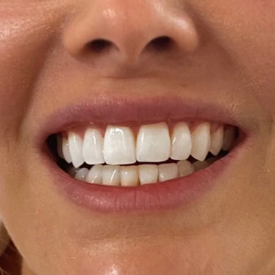 After treatment